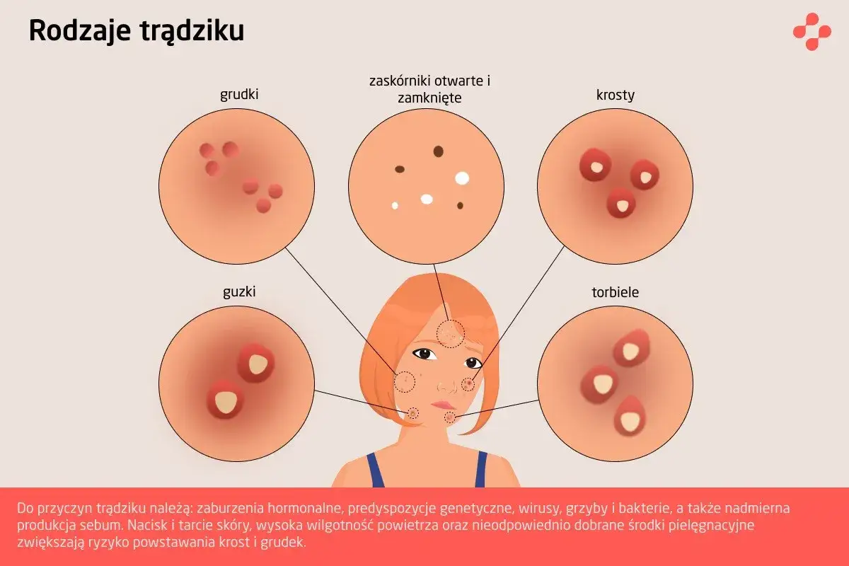 Przyczyny powstawania pryszczy, schemat skóry trądzikowej