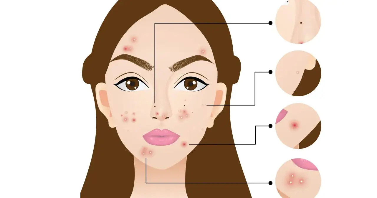 Rodzaje pryszczy, kt&oacute;re można i kt&oacute;rych nie można wyciskać